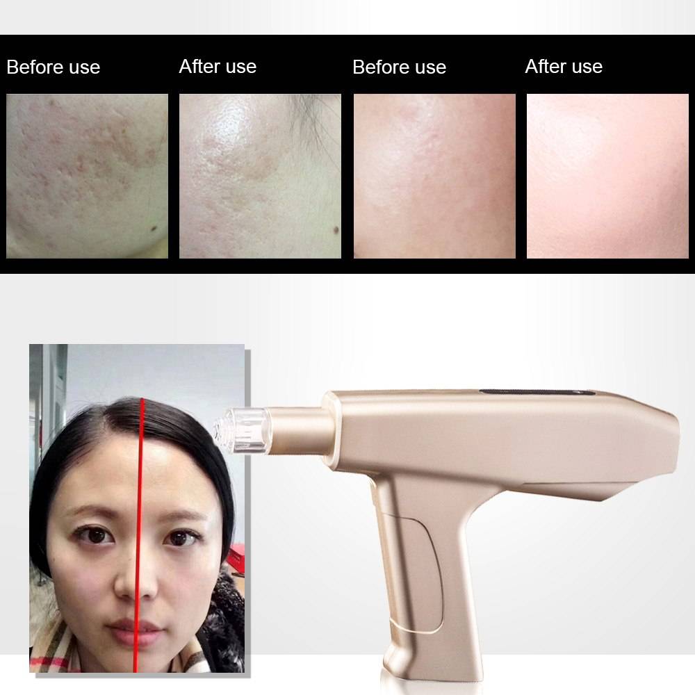 Microneedle Beauty Instrument